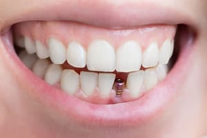 tooth implant risks