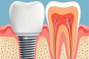 dental implants india