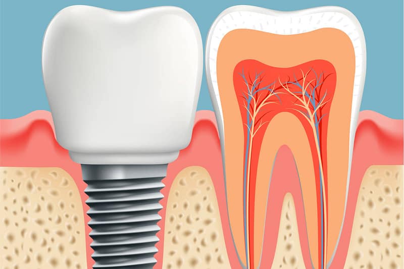 Interested in dental implants? India has the solution for you.