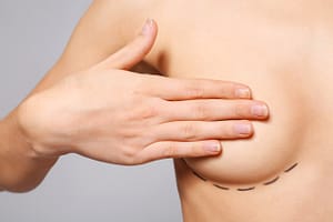 breast lift and nipple reduction