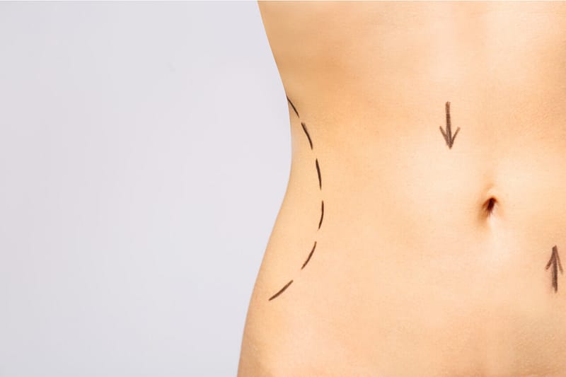 Instant abdominoplasty: Does the tummy tuck belt really work?