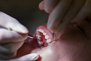 endodontically treated molars